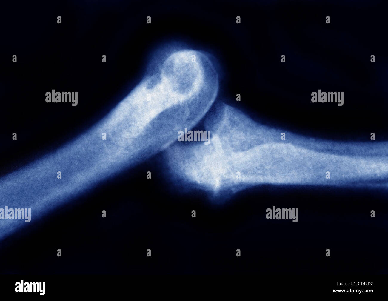 DISLOCATION ELBOW, XRAY Stock Photo Alamy
