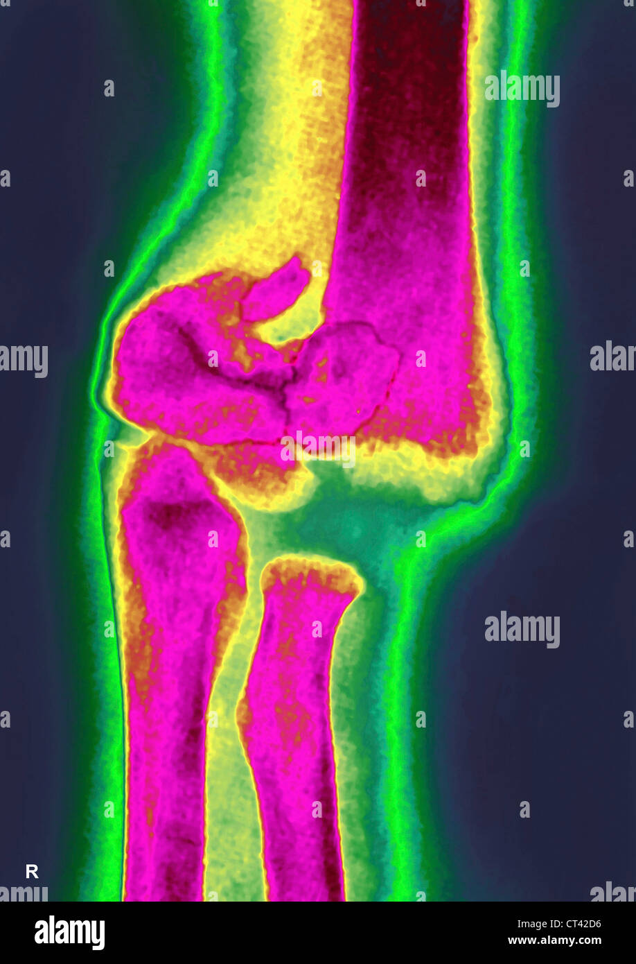 Fractured elbow hires stock photography and images Alamy