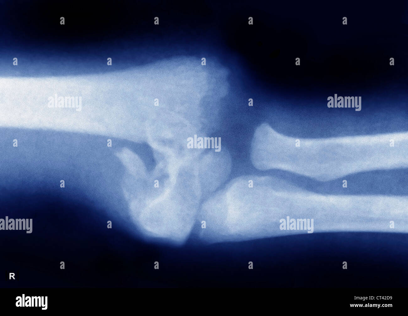 FRACTURED ELBOW, XRAY Stock Photo Alamy