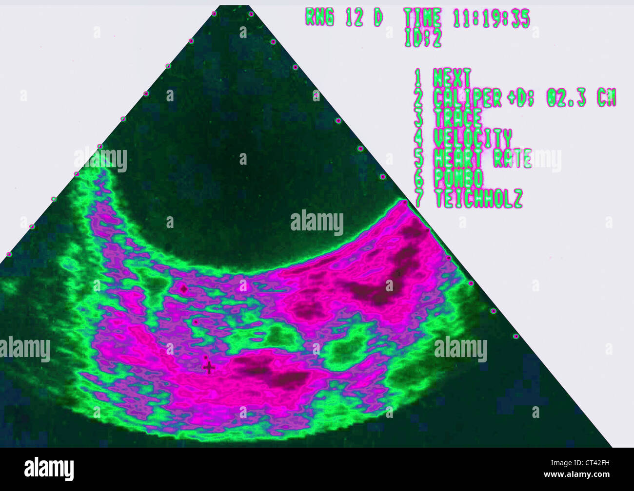 EXTRA-UTERINE PREGNANCY SONOGRAM Stock Photo