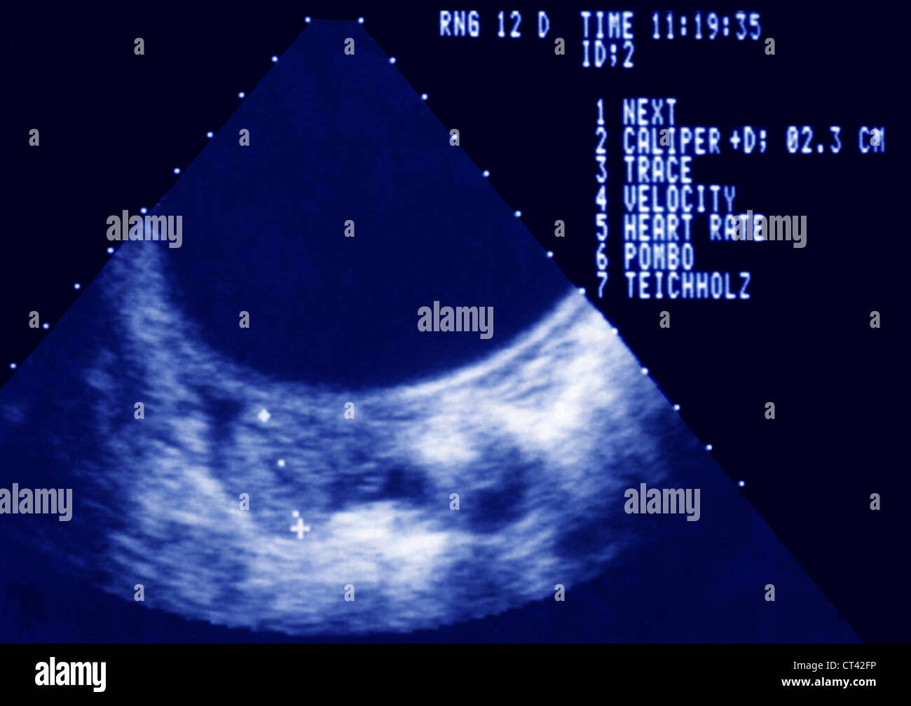 EXTRA-UTERINE PREGNANCY SONOGRAM Stock Photo