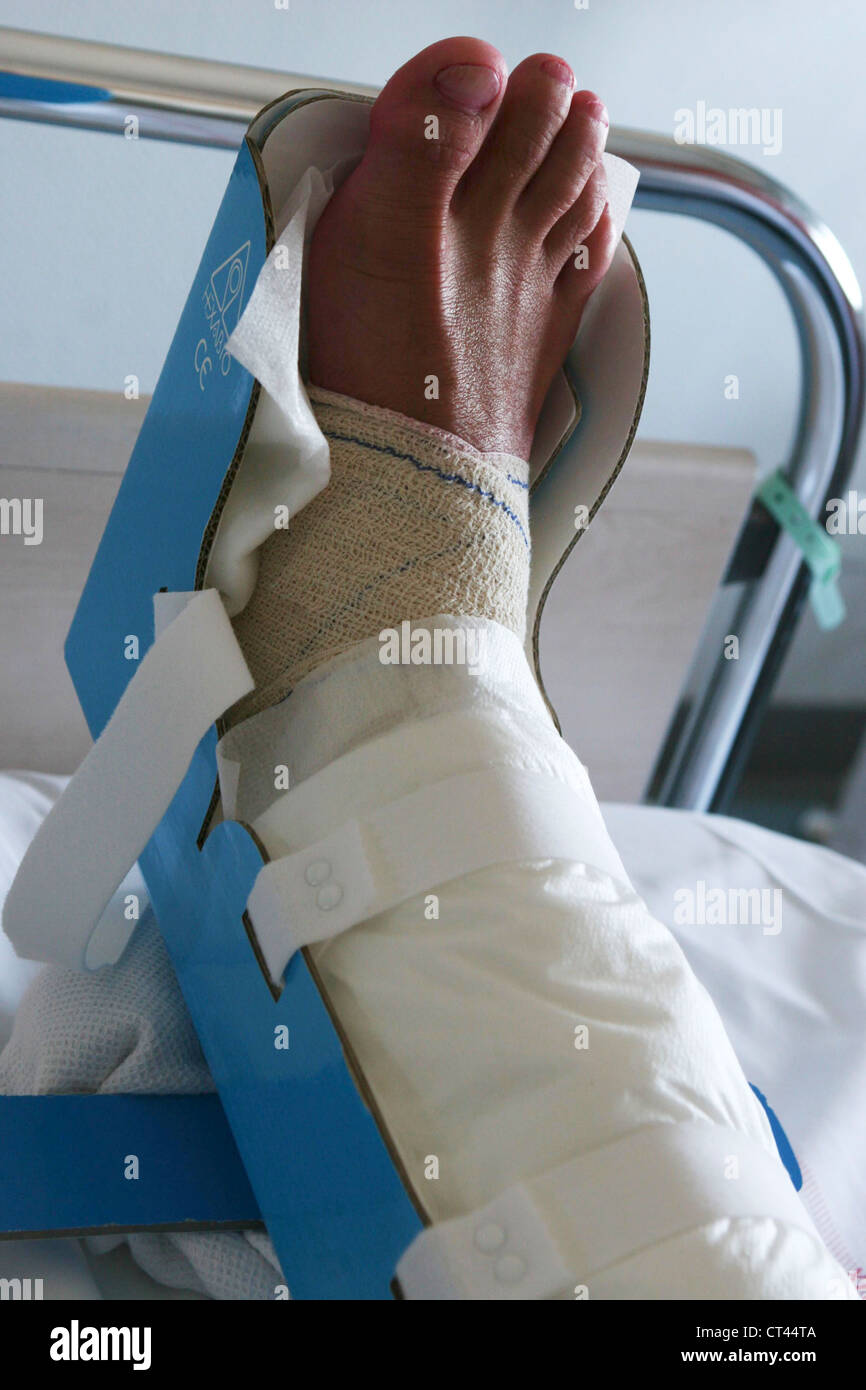 Fractures Of The Leg High Resolution Stock Photography and Images Alamy