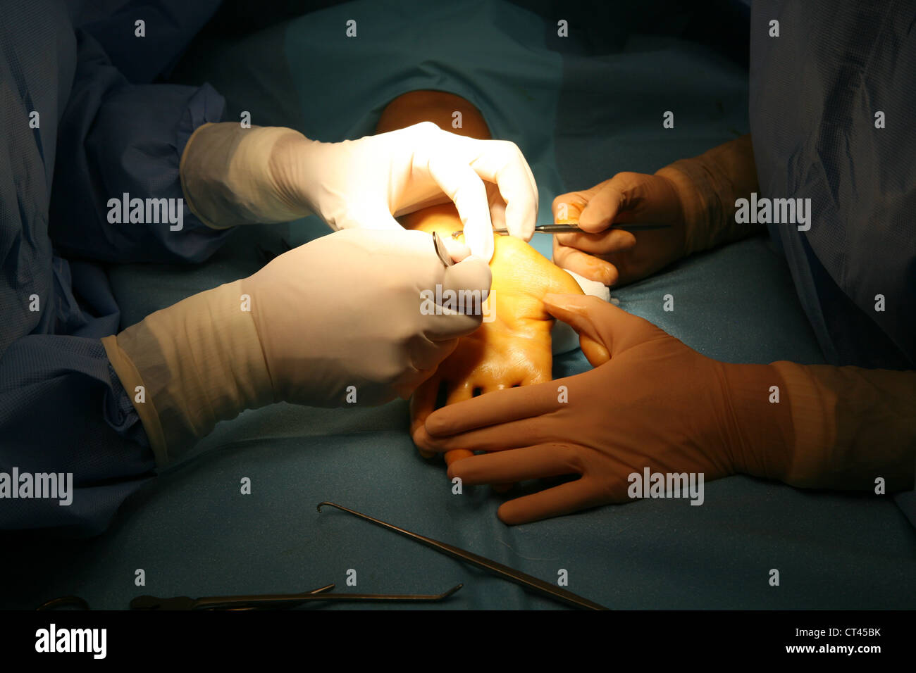 CARPAL TUNNEL, SURGERY Stock Photo - Alamy