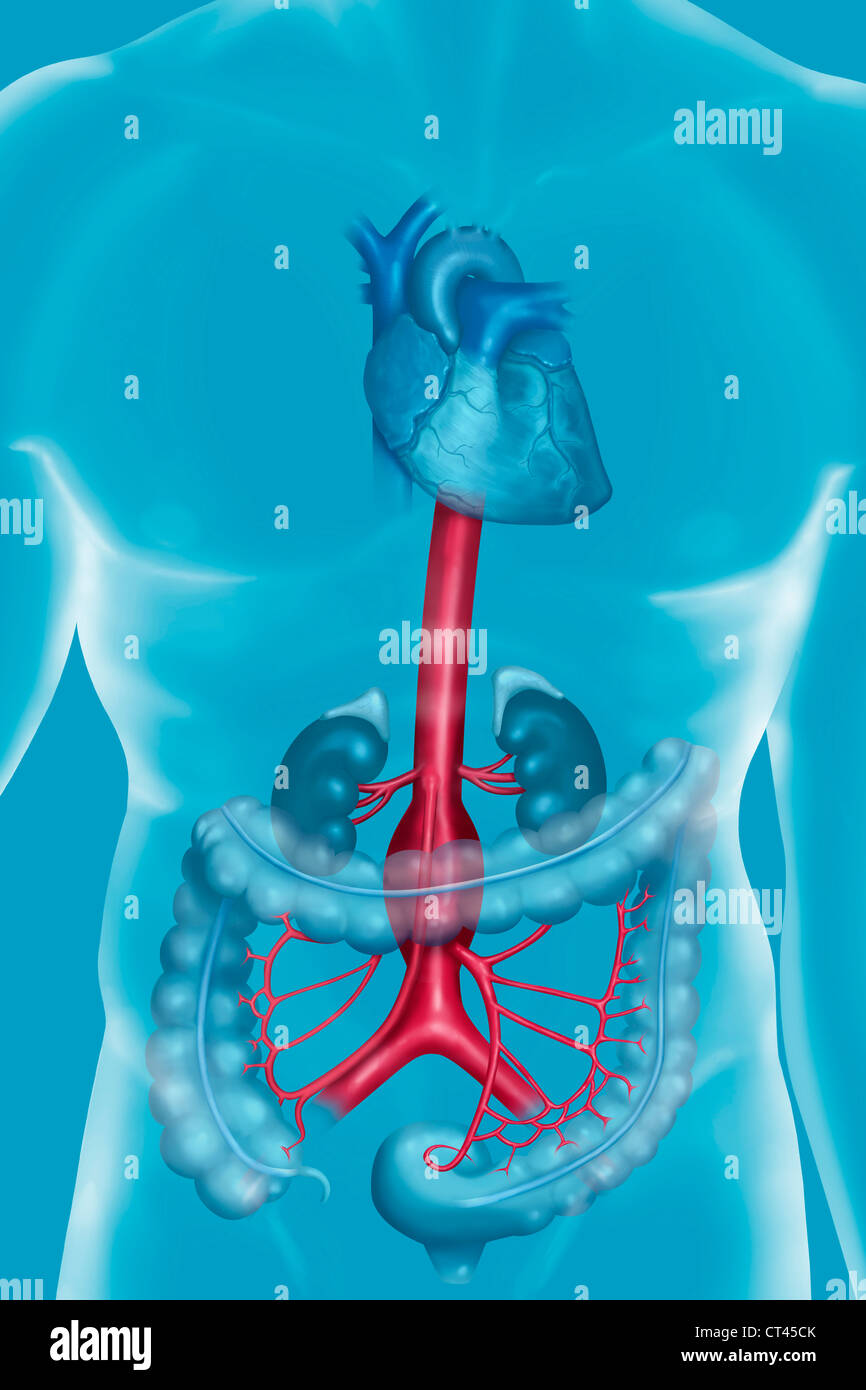 ANEURYSM OF THE ABDOMINAL AORTA Stock Photo