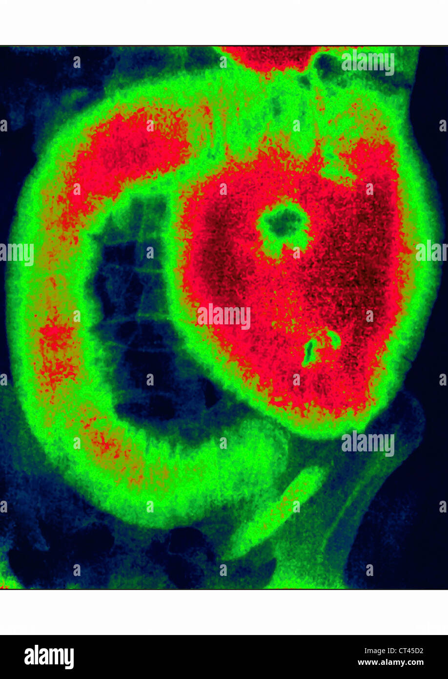 Blocked small intestine hi-res stock photography and images - Alamy
