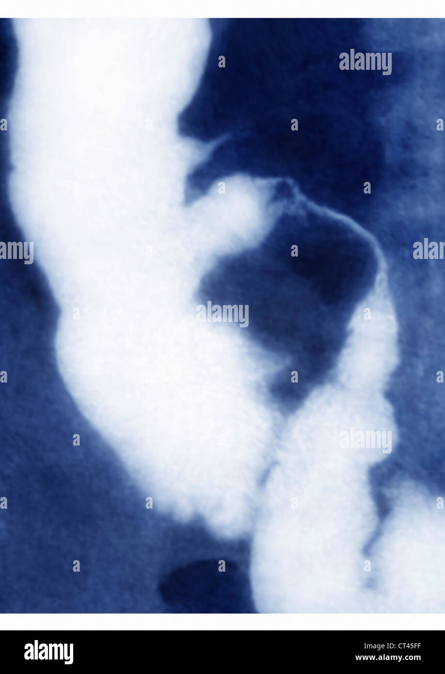 Ileitis hires stock photography and images Alamy