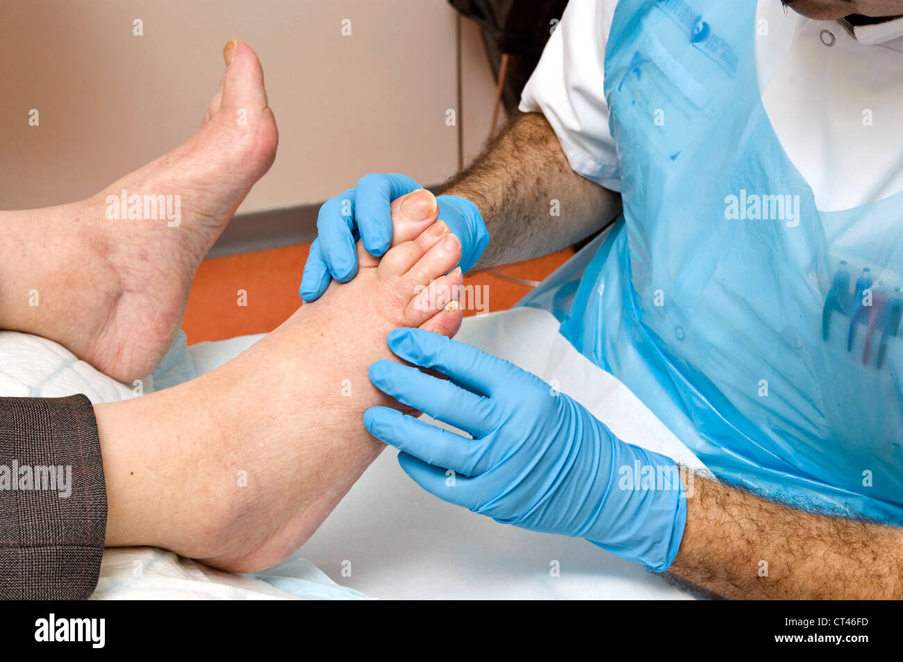 Diabetic foot wounds hi-res stock photography and images - Alamy