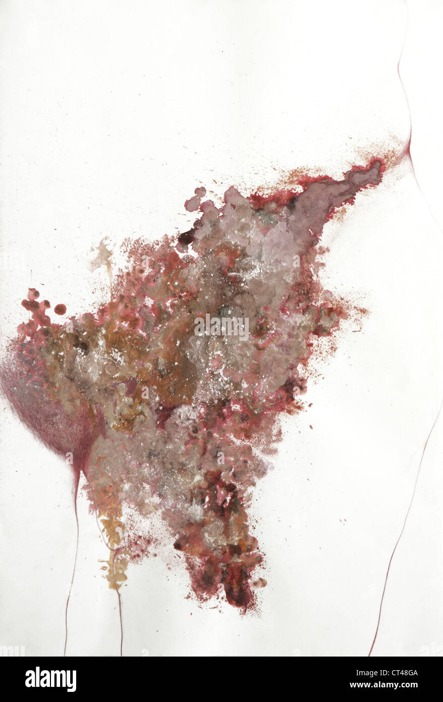 SKIN CANCER, DRAWING Stock Photo Alamy