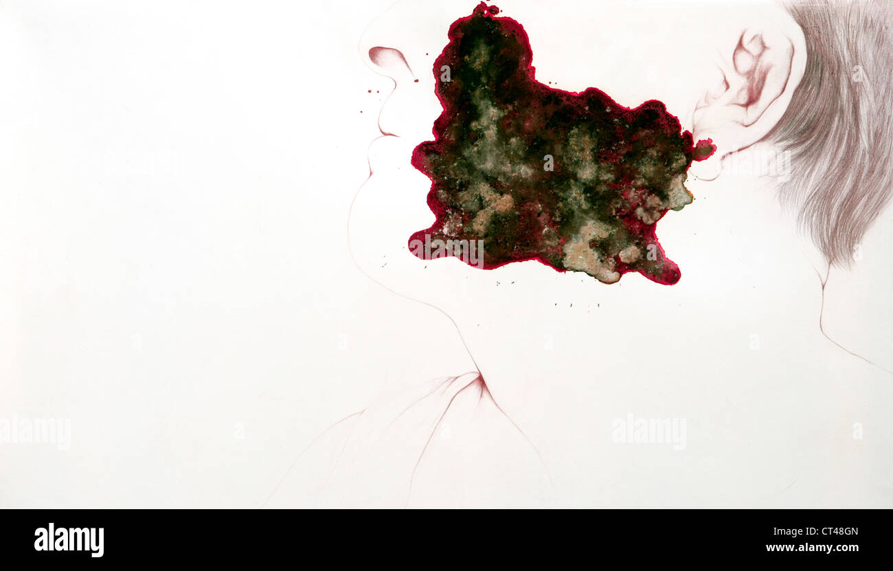 SKIN CANCER, DRAWING Stock Photo Alamy