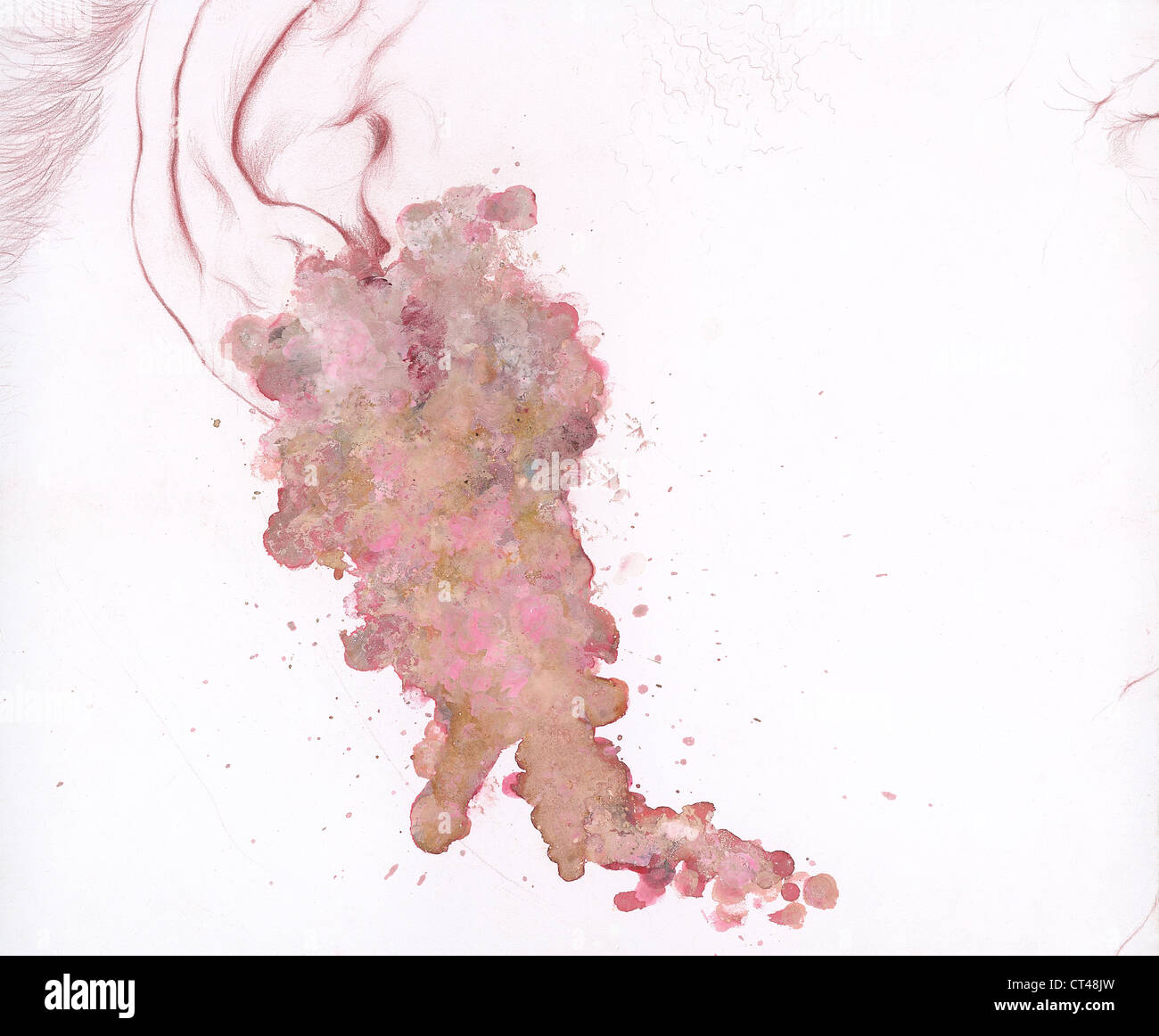 SKIN CANCER, DRAWING Stock Photo Alamy