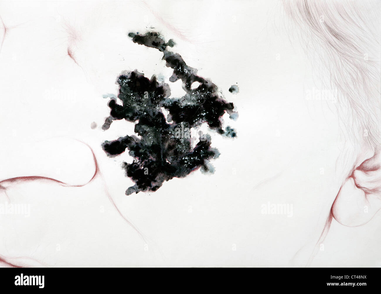 SKIN CANCER, DRAWING Stock Photo Alamy