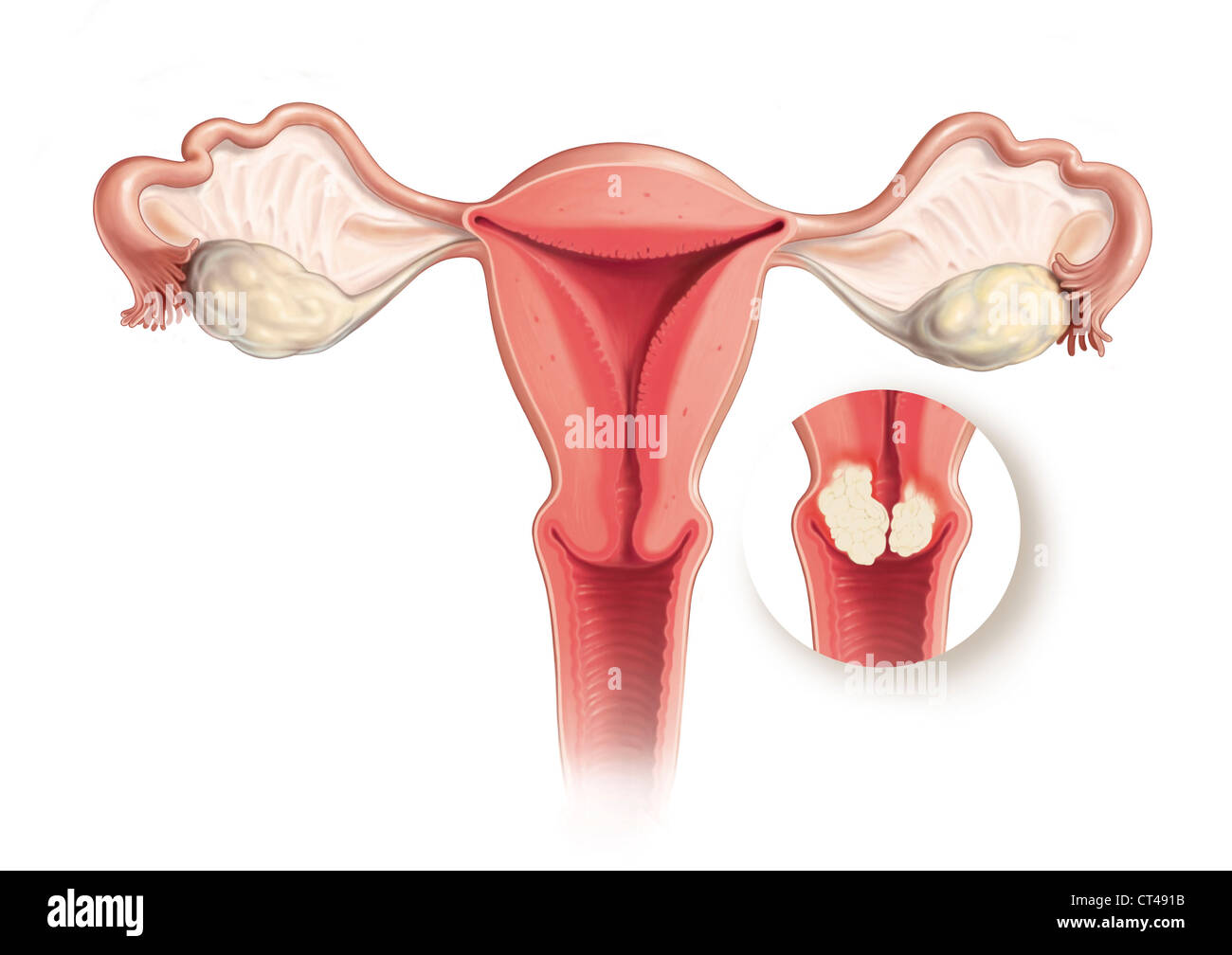 CANCER OF THE UTERUS, DRAWING Stock Photo - Alamy