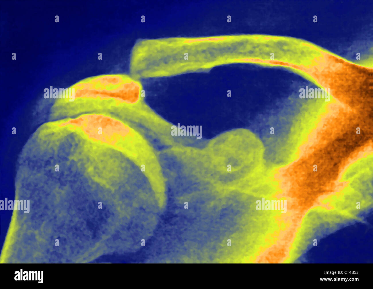 Collarbone x ray hires stock photography and images Alamy