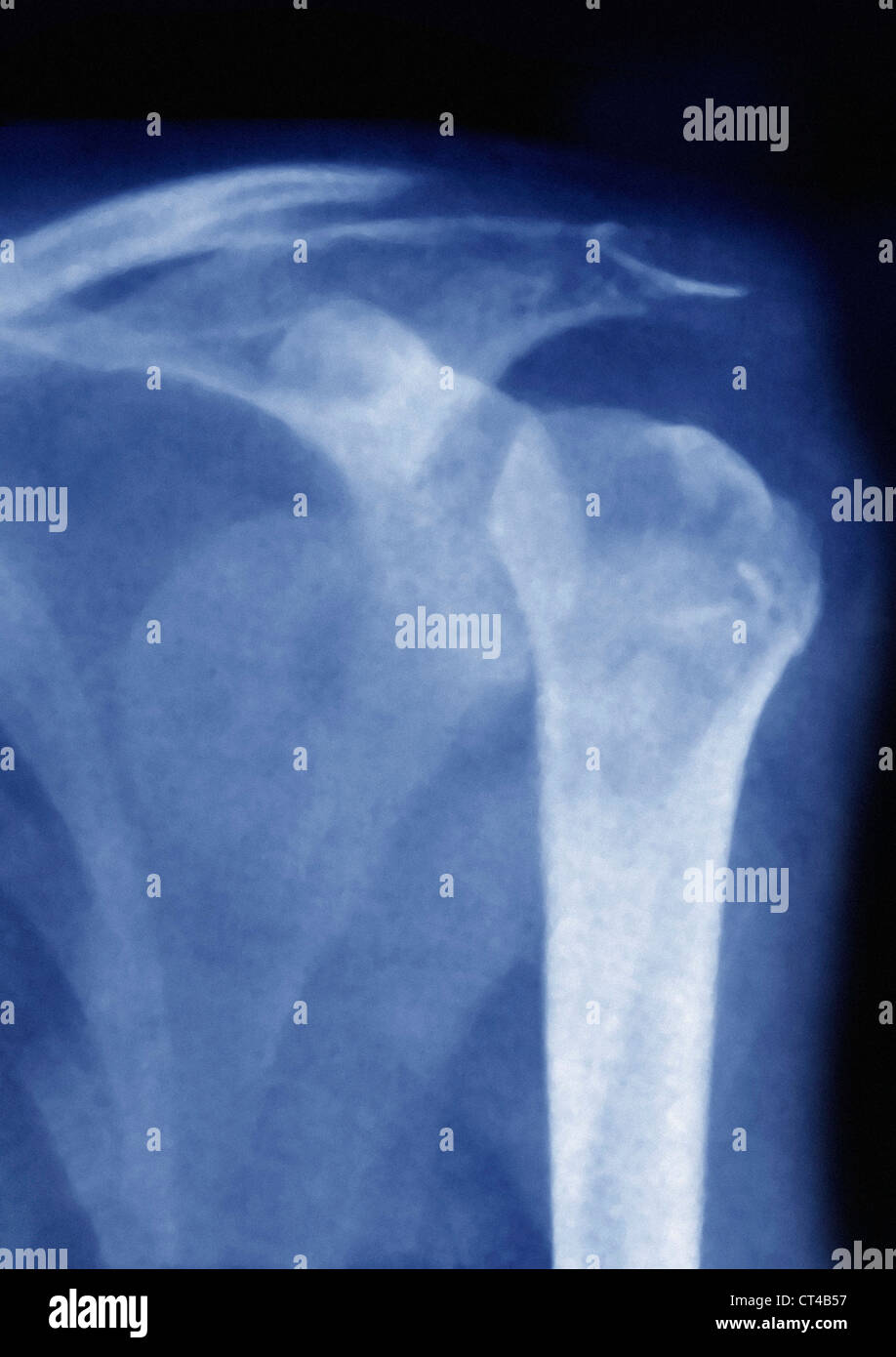 Shoulder Dislocation X Ray