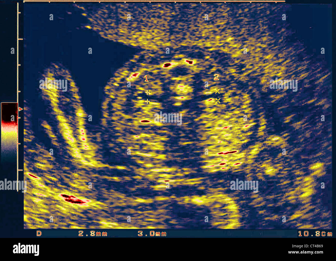6 month fetus ultrasound hires stock photography and images Alamy