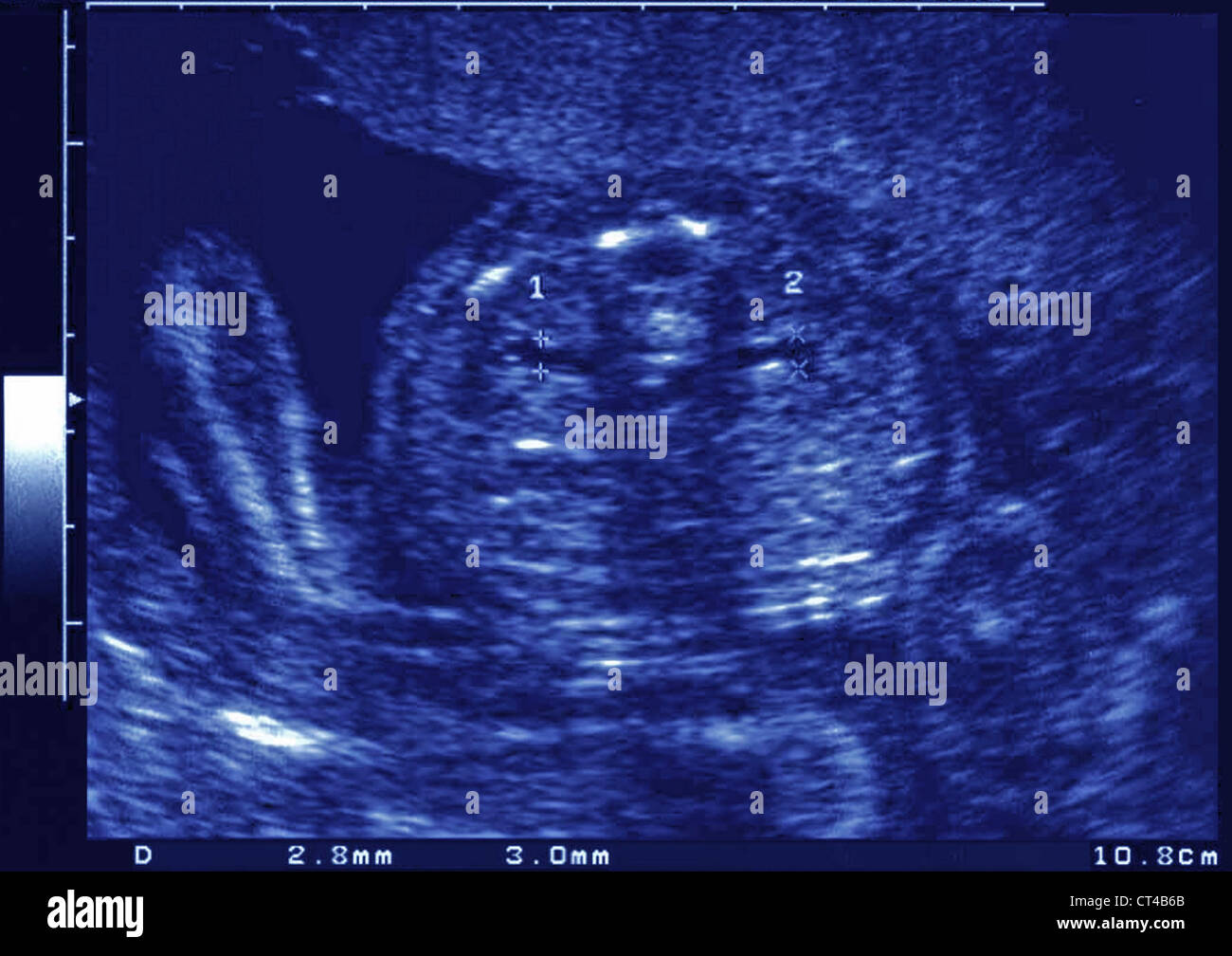6 weeks old fetus hires stock photography and images Alamy