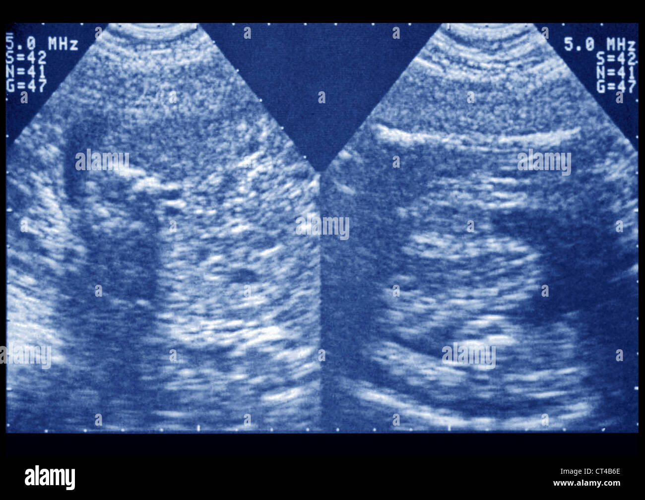 KIDNEY PTOSIS, ULTRASONOGRAPHY Stock Photo Alamy