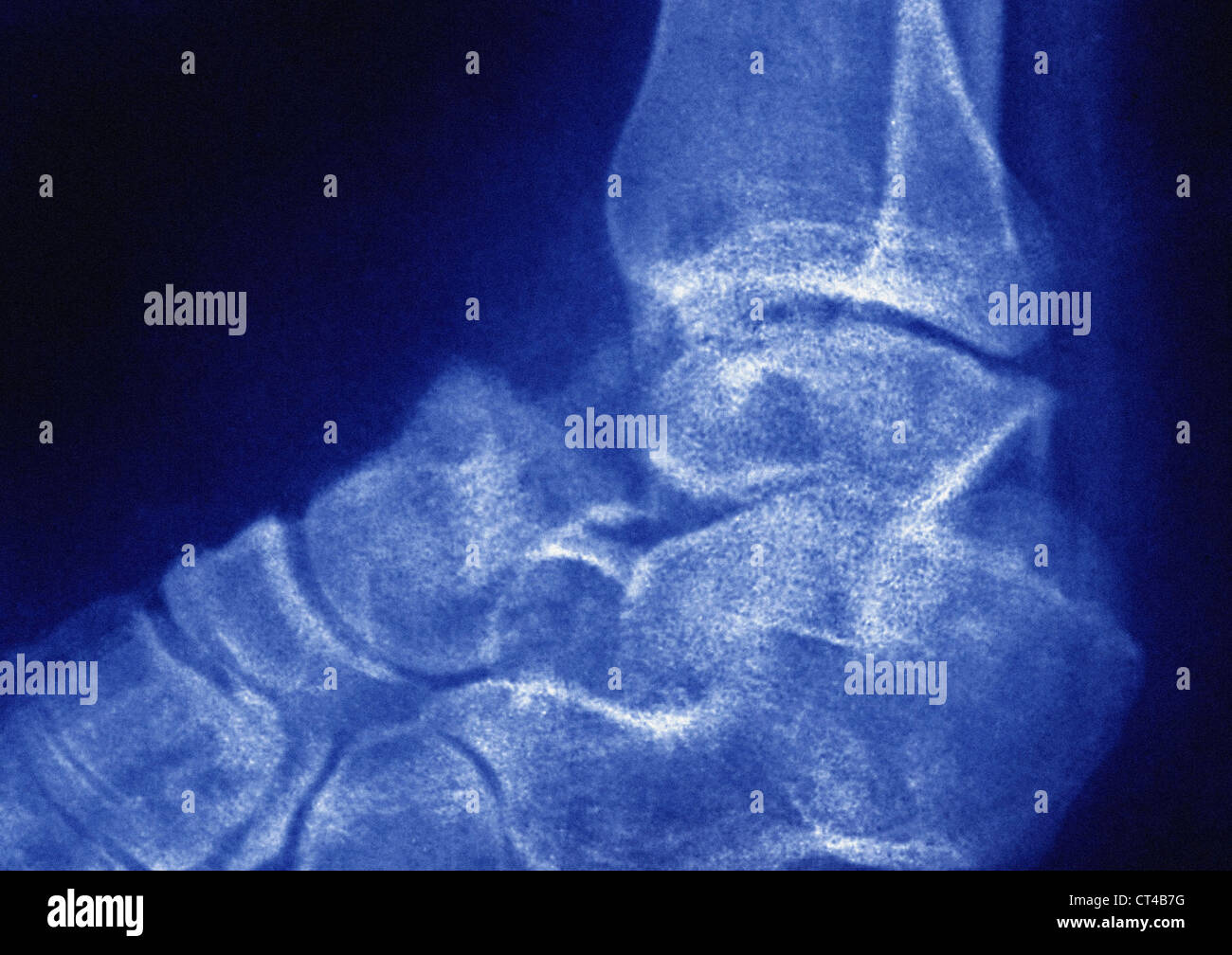 Fractured anckle bone hires stock photography and images Alamy