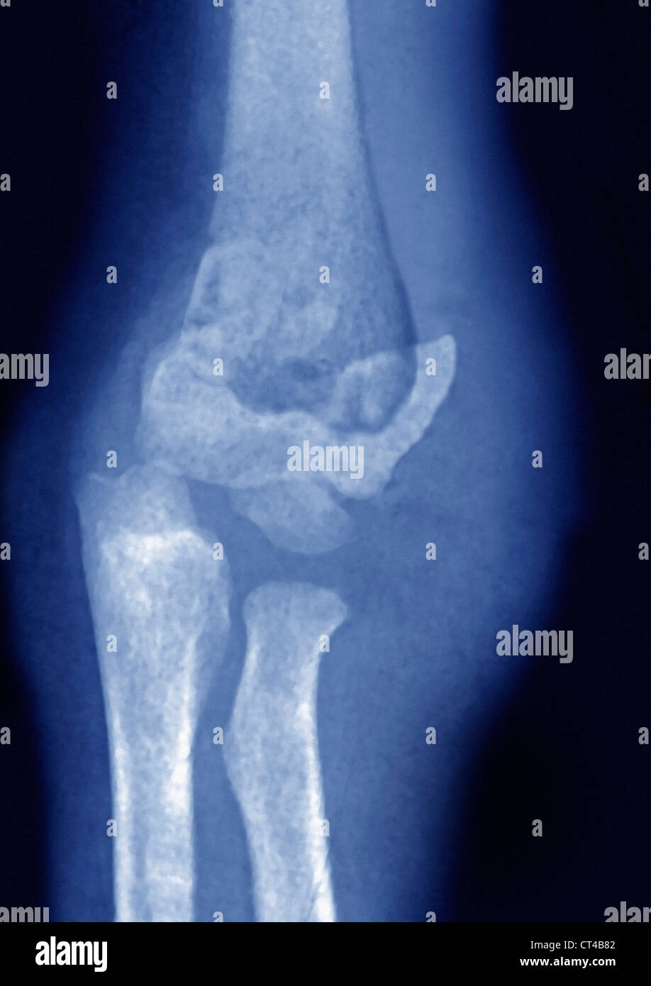 Fractured elbow hires stock photography and images Alamy