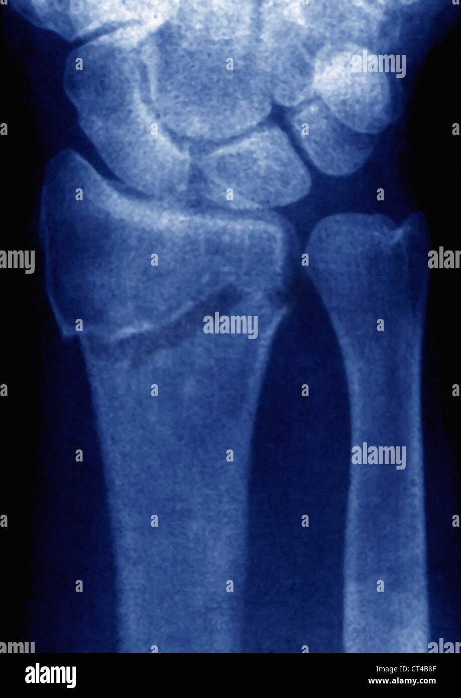 FRACTURED WRIST, XRAY Stock Photo Alamy