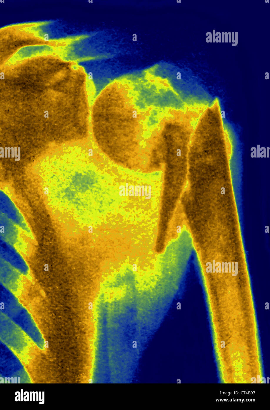 FRACTURED SHOULDER, XRAY Stock Photo Alamy