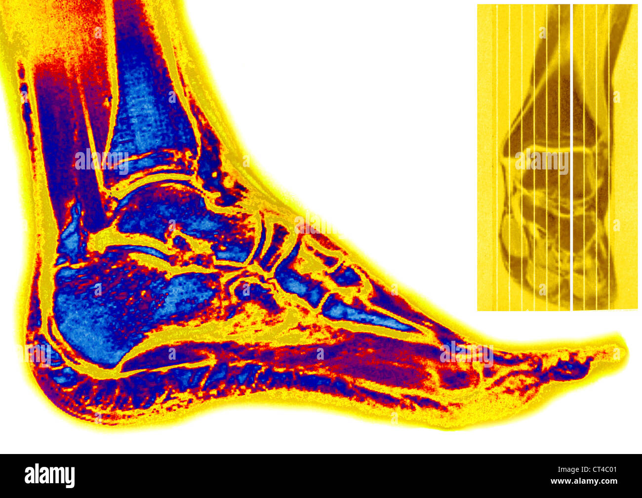 FOOT, MRI Stock Photo