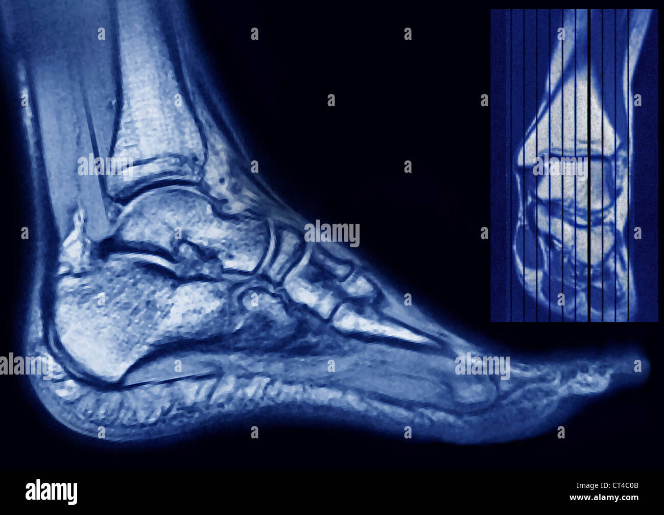 FOOT, MRI Stock Photo