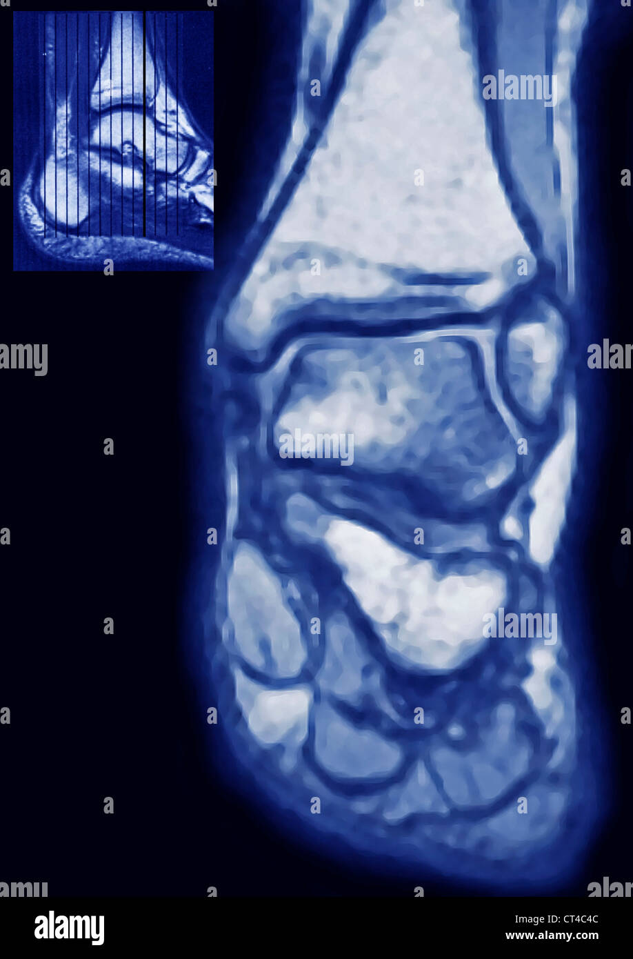Mri ankle hires stock photography and images Alamy