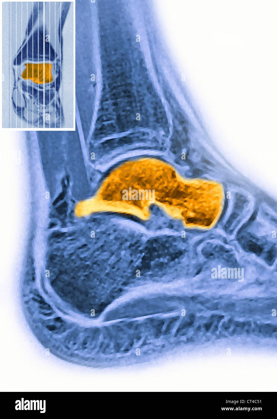 Nuclear bone scan hires stock photography and images Alamy
