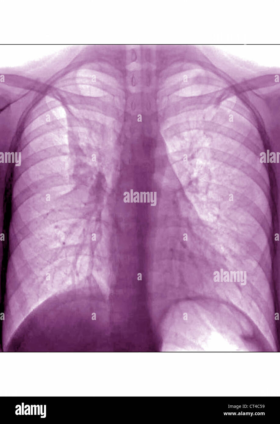 Asthma X Ray Stock Photos & Asthma X Ray Stock Images Alamy