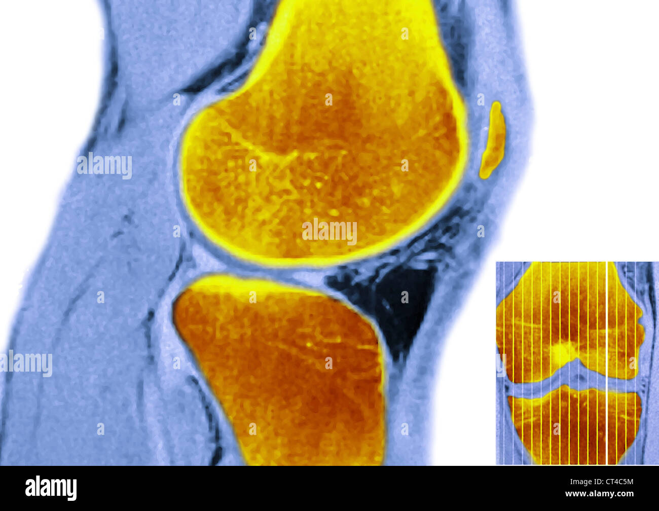 KNEE, MRI Stock Photo