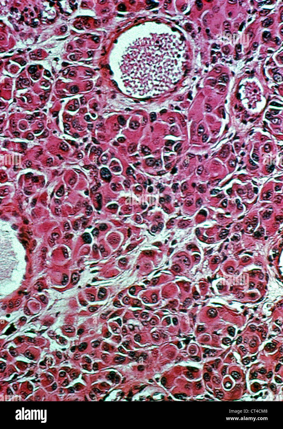 MELANOMA, HISTOLOGY Stock Photo Alamy
