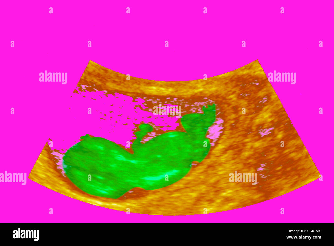 3 months fetus hi-res stock photography and images - Alamy
