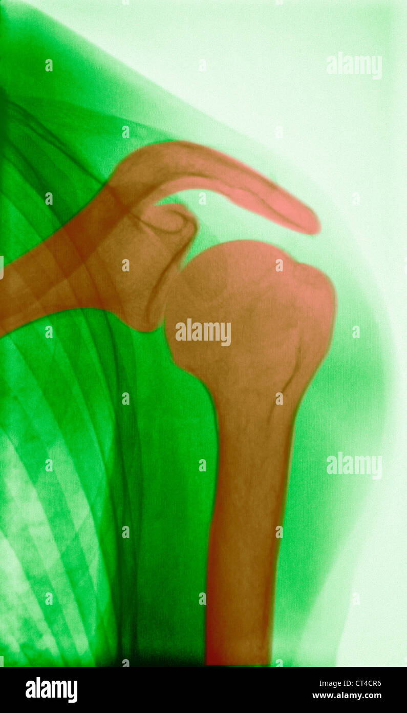 X ray shoulder human hires stock photography and images Alamy