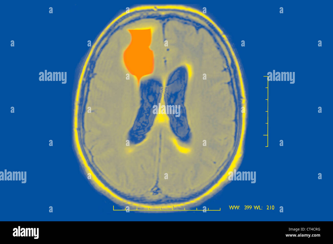 EPILEPSY, MRI Stock Photo