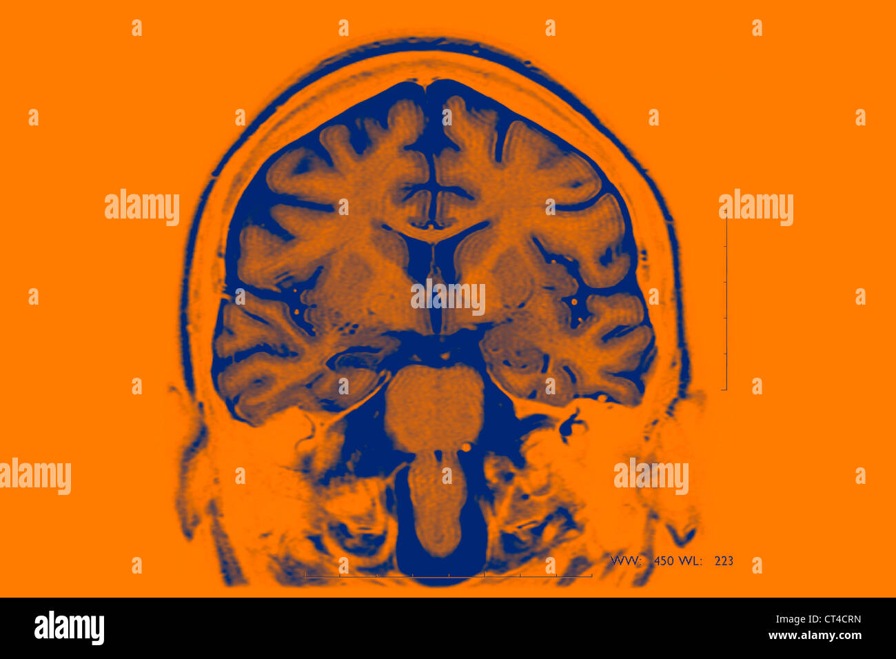 Epilepsy brain scan hi-res stock photography and images - Alamy