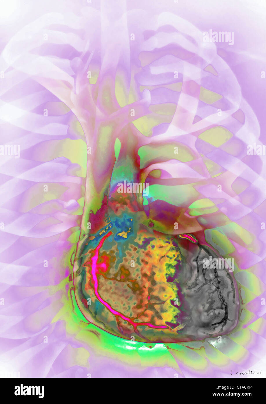 HEART ATTACK, DRAWING Stock Photo