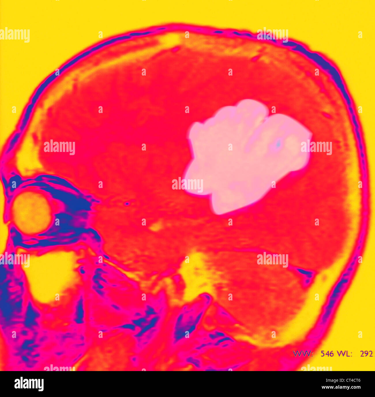T1 weighted mri hires stock photography and images Alamy