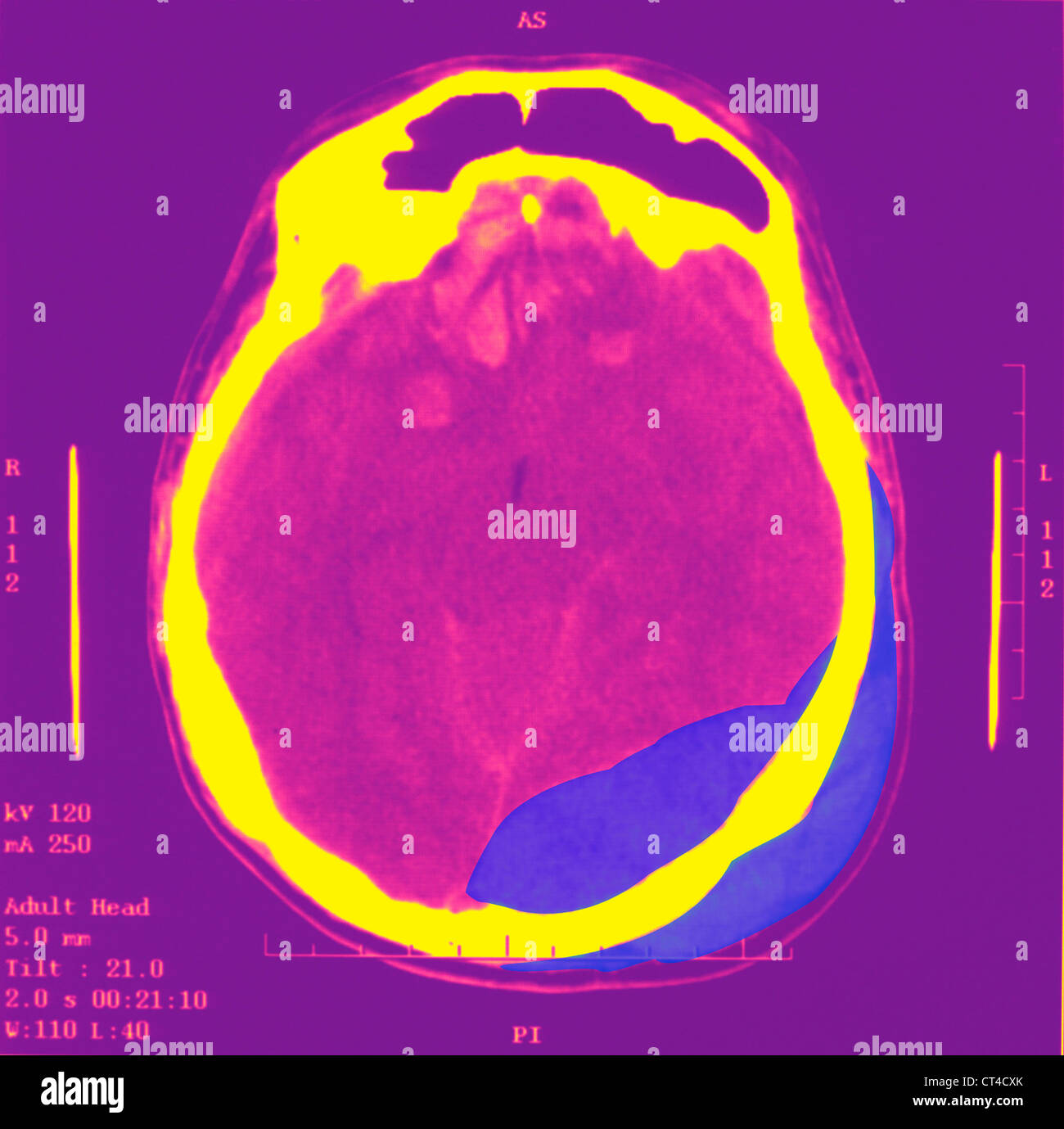 HEMATOMA, BRAIN SCAN Stock Photo Alamy