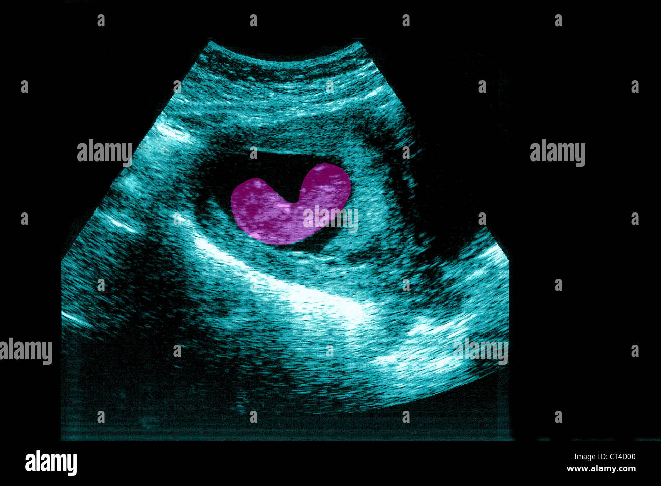 3 month fetus hi-res stock photography and images - Alamy