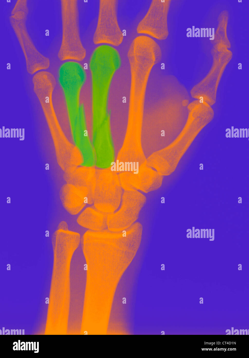 FRACTURED FINGER, XRAY Stock Photo Alamy