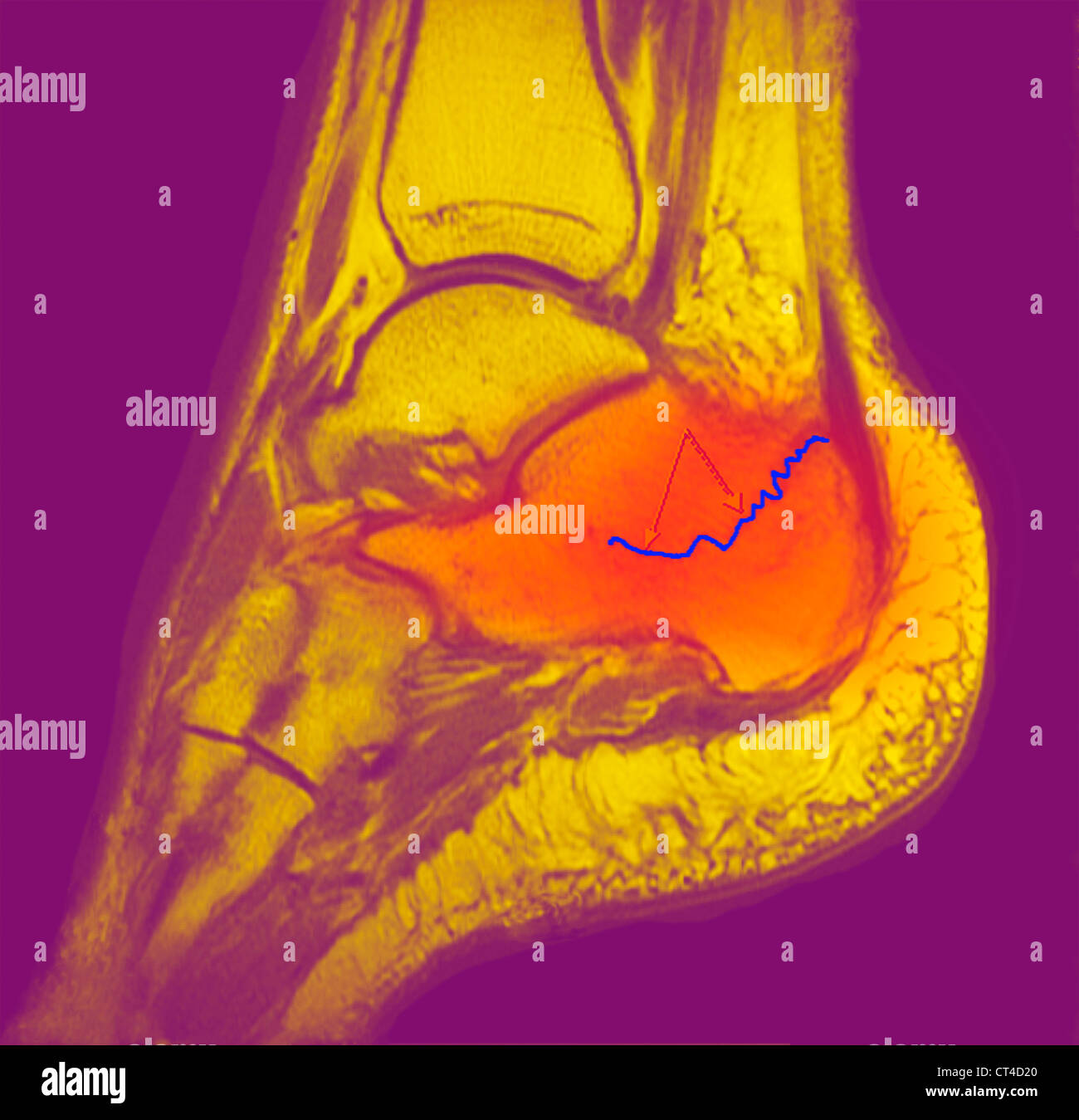 Calcaneum hi-res stock photography and images - Alamy