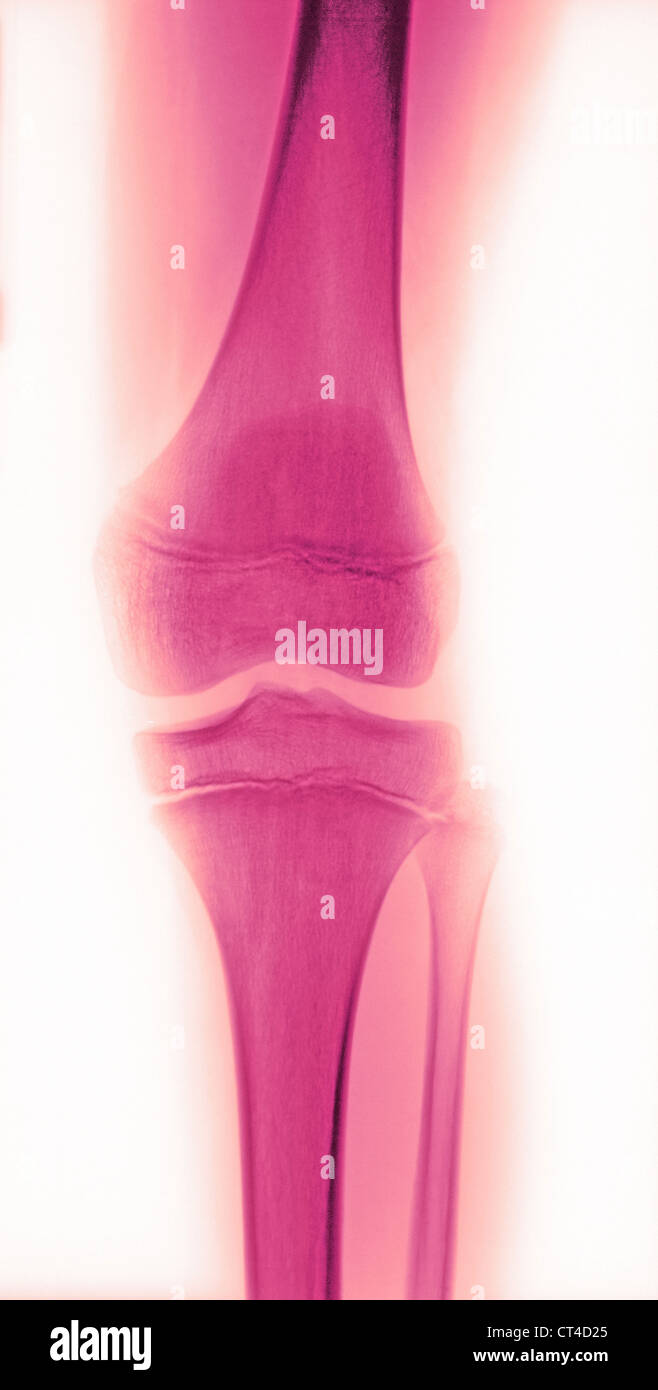 CHILD KNEE, XRAY Stock Photo Alamy