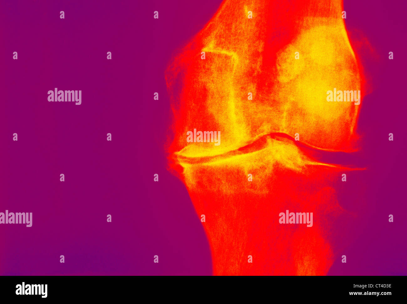 Knee osteoarthritis x ray hires stock photography and images Alamy