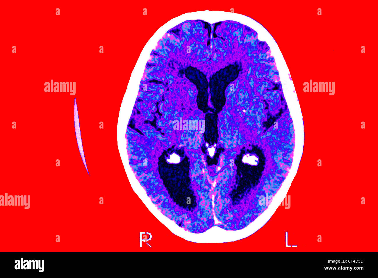 Dementia brain scan hi-res stock photography and images - Alamy