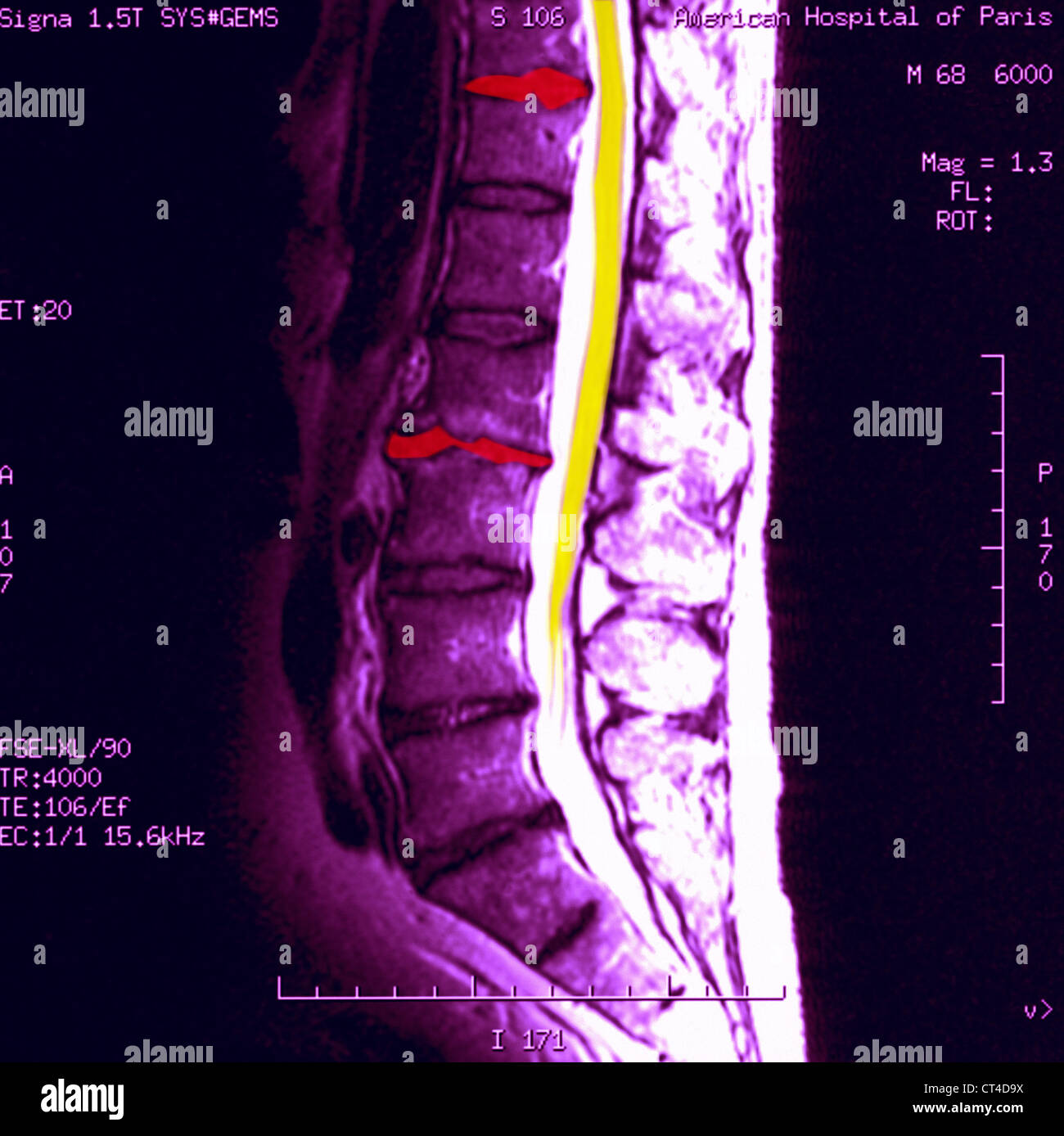 Mri of thoracic spinal cord hires stock photography and images Alamy