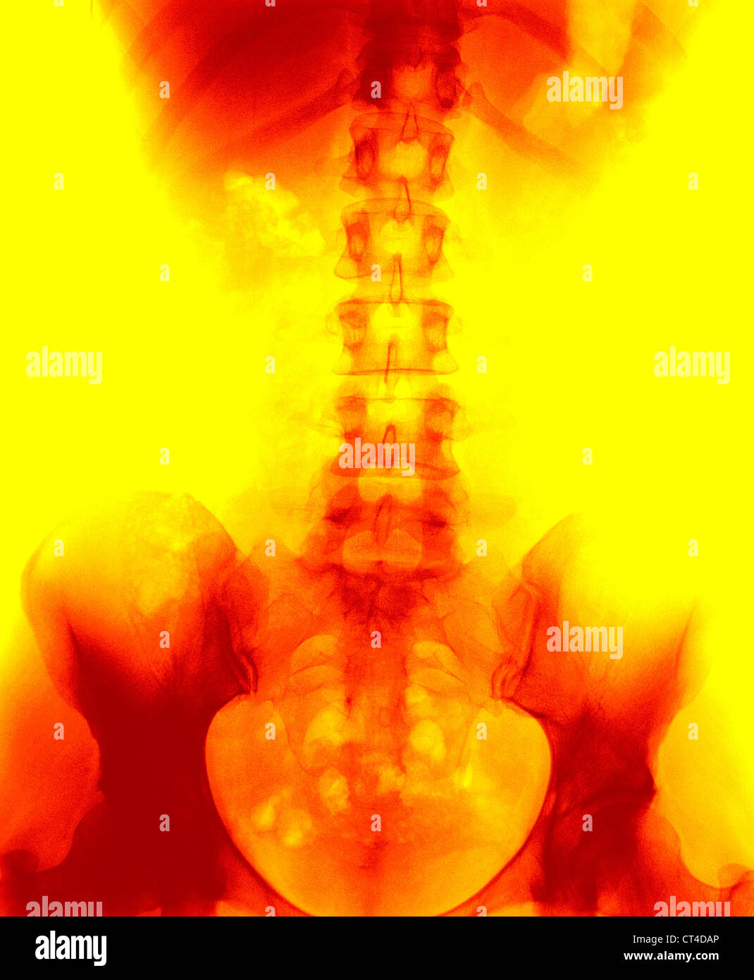 SPINAL COLUMN, X-RAY Stock Photo