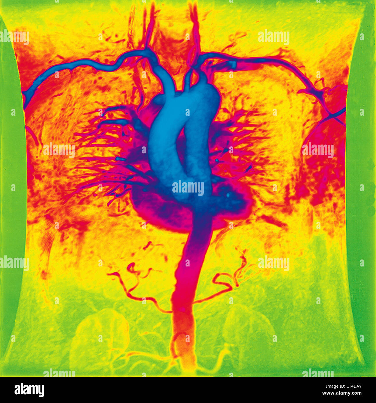 AORTA, ANGIOGRAPHY Stock Photo