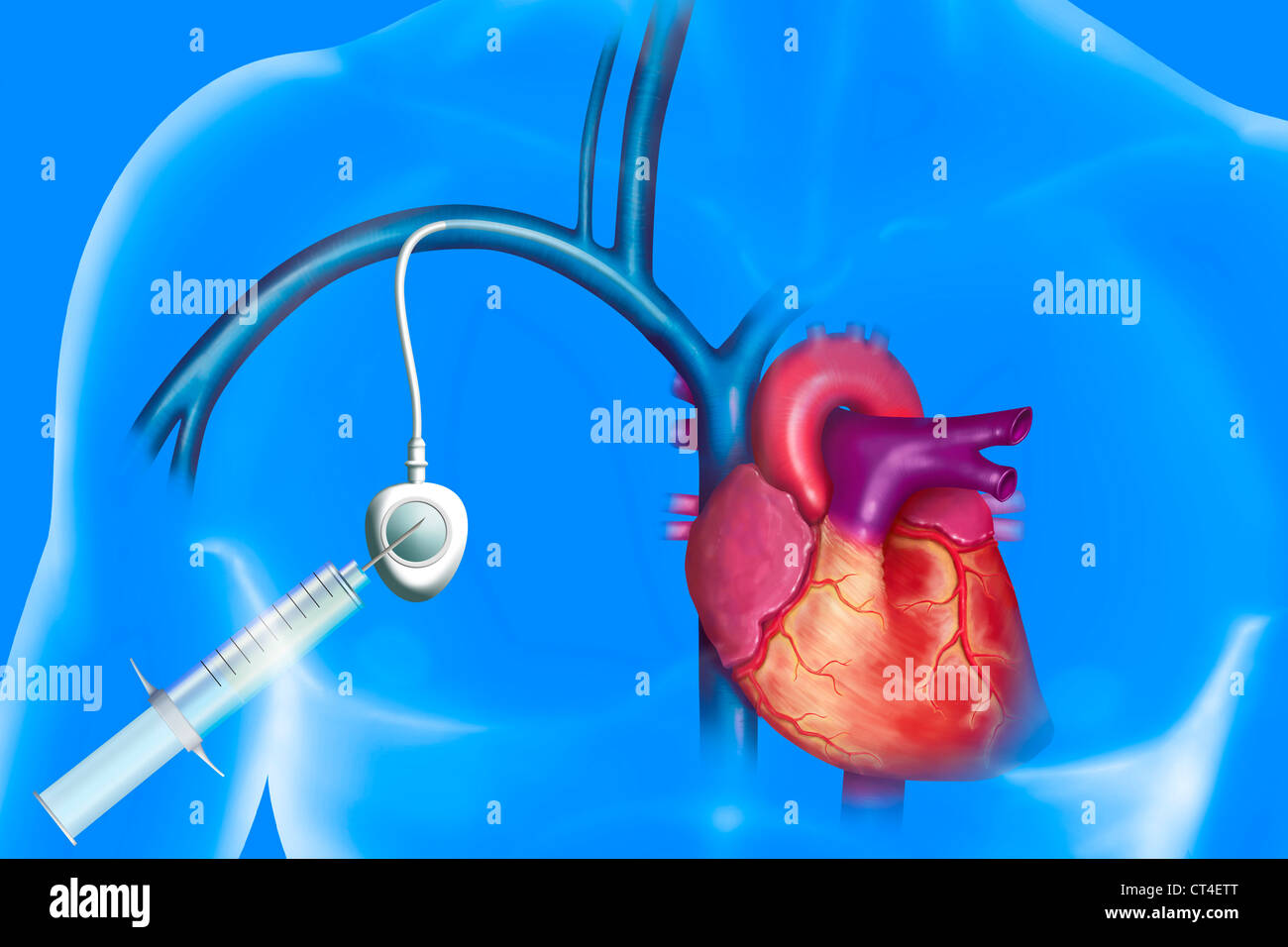 Types Of Venous Access Devices