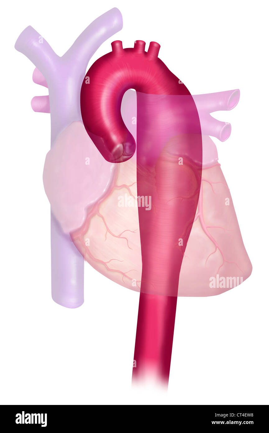 ANEURYSM OF THE THORACIC AORTA Stock Photo